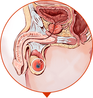 prosztatagyulladás oka herpesz és prostatitis
