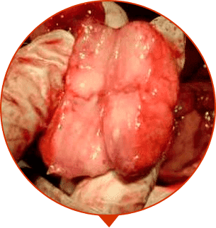Éles fájdalom a prosztata ejakuláció után